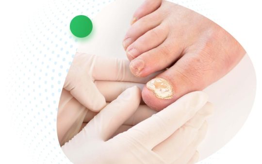 Which Drug Is Used To Treat Onychomycosis?